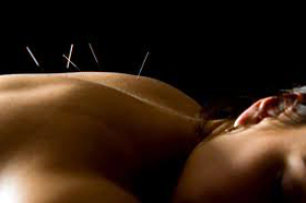 Acupuncture Wollongong
